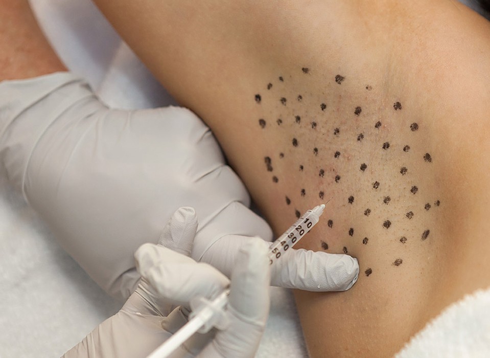 Microinyecciones en la axila para tratar la sudoración excesiva (hiperhidrosis) en una consulta de medicina estética en Valladolid